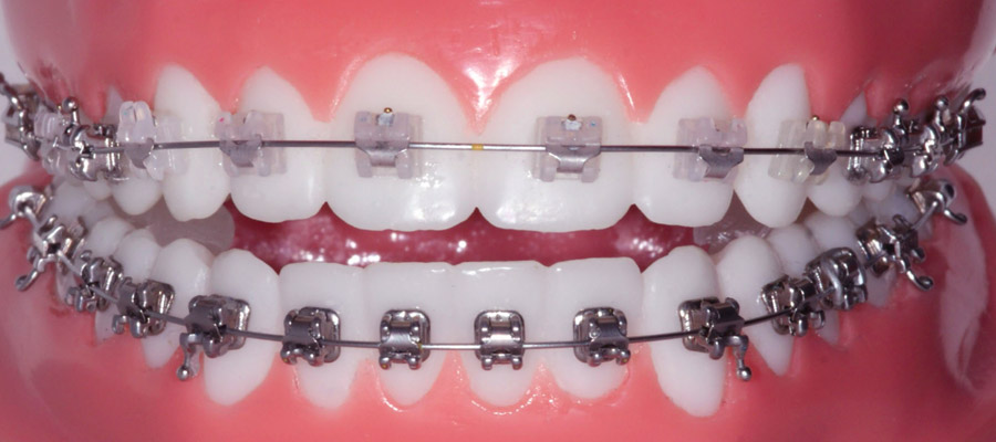 l’orthodontie adulte
