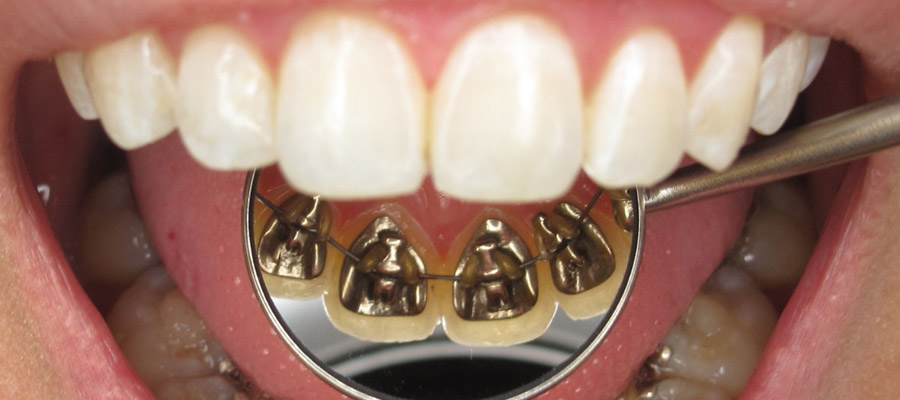 orthodontique pour adultes