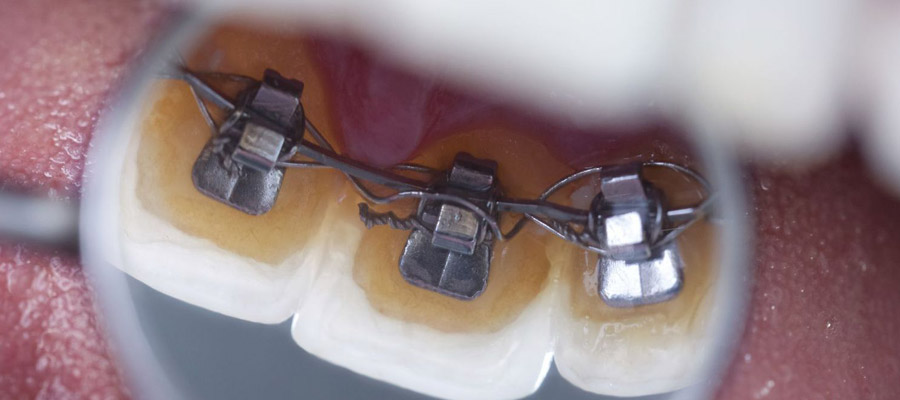 orthodontique amovible