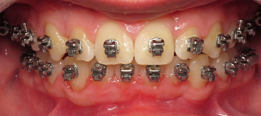orthodontique pour adulte