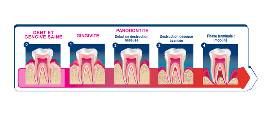 maladie parodontale